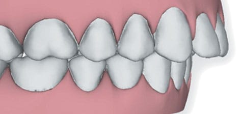 Underbite image