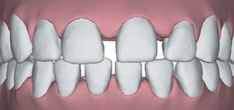 Underbite image